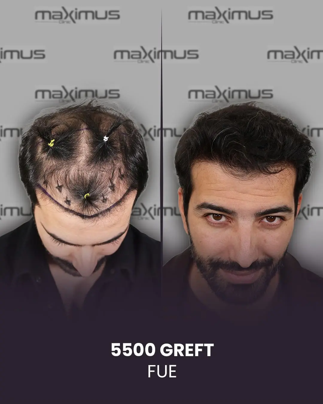 DHI Method: Unshaven and Dense Hair Transplant